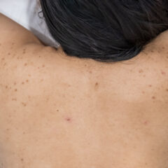 Let’s Treat Bacne at Home